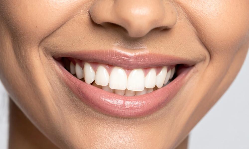 sbiancamento dentale Padova